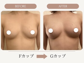 バストアップ専門店 ウェルバスト 福岡天神店(Well Bust)/【バストアップ例】F→Gカップ