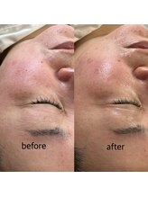 プルナモ(Purnama)/シミ集中ケア