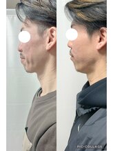 カノア(KANOA)/お顔のぽにょ取り