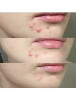 ジョンミー(JONMEE)/ハーブピーリングでニキビケア!