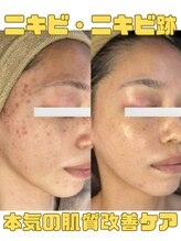 アディス 心斎橋(ADISE) 人気No.3 肌質改善