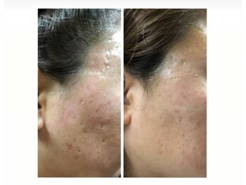 エステ デ アイリス(Esthe de Iris)/スポンジアトリートメント