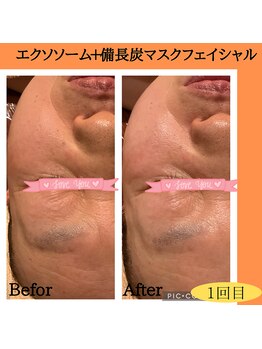 パルティノ 高崎店/エクソソーム＋備長炭マスク