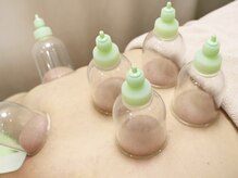 柏鍼灸整骨院/カッピングで血行促進！