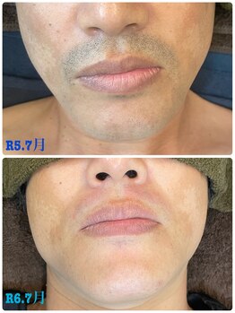 脱毛革命CRR 今池店/【脱毛革命CRR今池店】