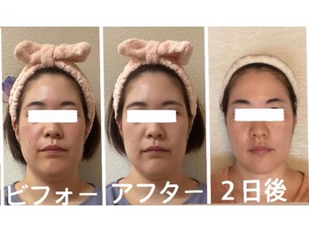 アクアナチュラ(ACQUANATURA)/顎周りがスッキリ