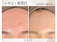 スリースリー(THREE THREE)/ニキビ・肌荒れケア