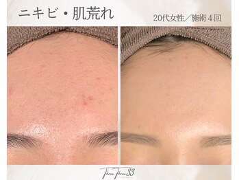 スリースリー(THREE THREE)/ニキビ・肌荒れケア