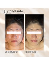 ココリ(CoCoRe)/Hy peel into 赤み軽減！