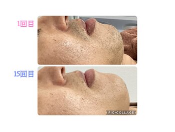 リオンズ 柏駅前店/ヒゲ脱毛9ヶ月目