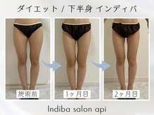 アピ(api)/症例写真【痩身インディバ】