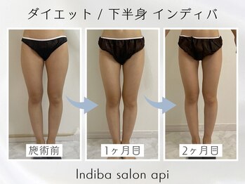 アピ(api)/症例写真【痩身インディバ】