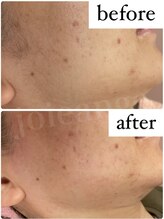 ジョアアンジェ 京橋店(joie ange)/顔ワックス脱毛で産毛もキレイに