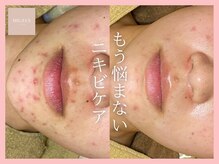 ミーラヤ(MILAYA)/梅田毛穴/梅田リアボーテ