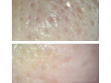 カシェート(cachette)/毛穴ケア