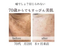 キラリ(kirari)/素敵なお客様のご感想｜肌質改善