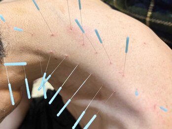 とだ鍼灸院の写真/理学療法士/鍼灸師/柔道整復師の資格保有『首・肩こり・腰痛改善に特化した鍼灸』で諦めていた症状も解消◎