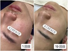 リンフェイス 銀座店(RIN FACE)の雰囲気(メンズにも人気のフェイシャルサロン♪毛穴/ニキビ/エイジング)