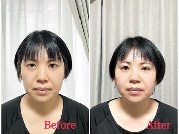 シルフィード/面長の顔が短くなりました