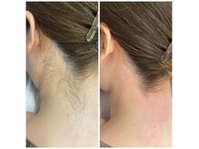 自分で出来ない箇所はプロにお任せ！うなじ脱毛/VIO脱毛/男性