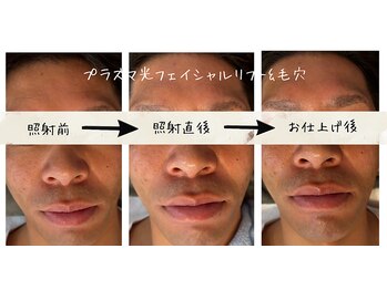 サロン リノ(salon rino)/プラズマ光フェイシャル