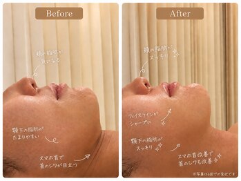 アセンド(ASCEND)の写真/【韓国最新コルグン導入】脂肪分解×EMSで頑固な顎下の脂肪にも◎次世代コルギで自分史上最高小顔に♪