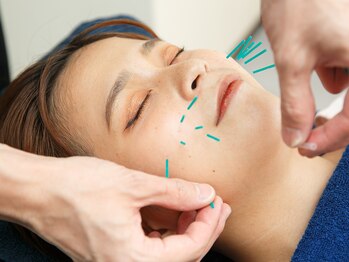 ハリハリ(HALIHALI)/お顔の鍼施術☆