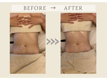 フェリチタトウキョウ(Felicita Tokyo)/インディバBeforeAfter_お腹