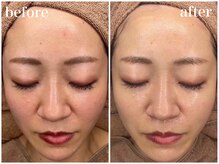 ホワイトアクア 天王寺本店(WHITE AQUA)/ララピールでツヤ肌に/天王寺