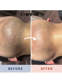 オフ(off)/ヒゲ脱毛