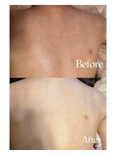 リリベル(LilyBell)/Before After