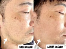 ミルダ(MIRUDA)の雰囲気（青髭解消/毎朝の髭剃りが楽に/肌荒れ予防にも【大宮髭脱毛】）