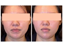 キラン 神戸店(Kiran)/即効性のある小顔施術は背中から