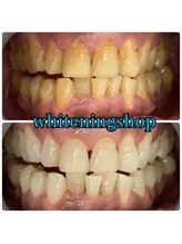 ホワイトニングショップ 豊橋店(WHITENING SHOP)/Before&After豊橋ホワイトニング