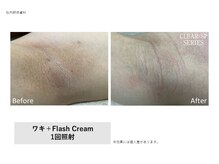 ビューティーラウンジ 自由が丘(BeautyLounge)/クリアグロウ脱毛　黒ずみ改善◎