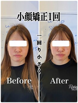 リバイブ 五反田店(REVIVE)/小顔矯正1回《リフトアップ》