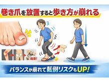 巻き爪じゅん 千葉駅前店/巻き爪放置歩行悪化と頭痛リスク