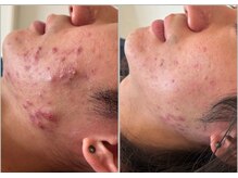 ナンバーナイン(No.9)/ニキビケア・毛穴ケア