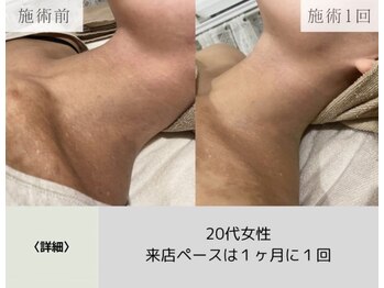 ボータン 恵(Beau Temps)/ハーブピーリング