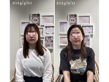 アネラ 本町(ANERA)/小顔矯正&毛穴洗浄BeforeAfter