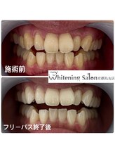 ホワイトニングサロン 京都烏丸店/ホワイトニング施術例