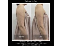パルファンドゥー(parfum doux)/痩身【二の腕】ビフォーアフター