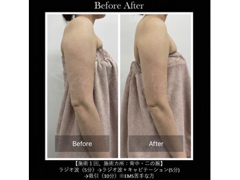 パルファンドゥー(parfum doux)/痩身【二の腕】ビフォーアフター