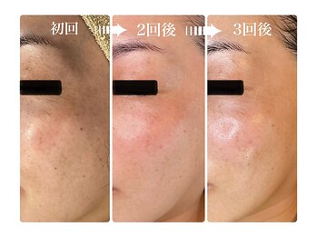 キレイ(KIREI)/初回→2回後→3回後