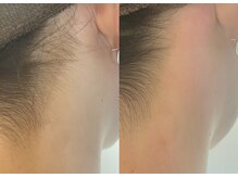 フォクシーワックス 立川店(FOXY WAX)の雰囲気（うなじワックス＋LED光脱毛のデザイン照射が大人気！！）