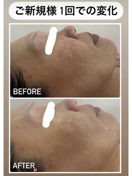 エスプラス エヌプラス(S+/N+)/フェイシャルエステ　ビフォアフ