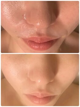 マリエンドリー/ざらつき/毛穴