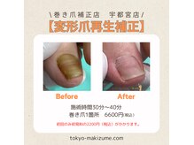 変形爪・分厚い爪再生補正