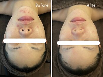 レイ(REI)/◆アクネケア◆