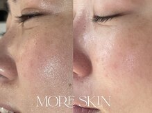 モアスキン 南青山店(MORE SKIN)/保湿美容液